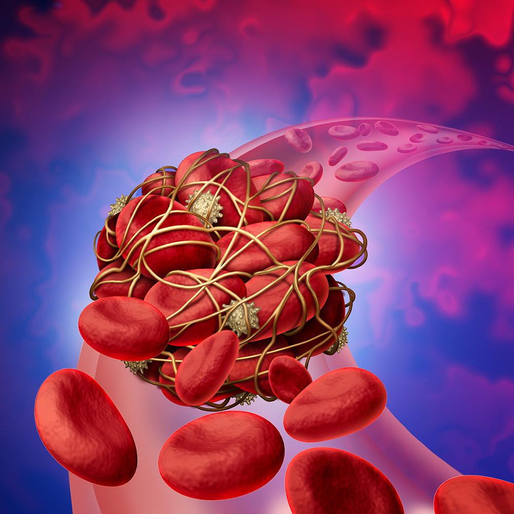 Blood clot health risk or thrombosis medical illustration concept as human blood cells clumped together with sticky platelets and fibrin as a blockage in an artery or vein